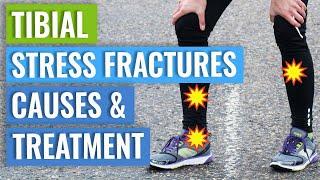 Tibial Stress Fractures - Treatment & Healing Times