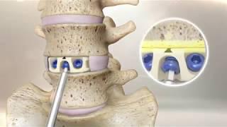 Centinel Spine: MIDLINE II Surgical Animation