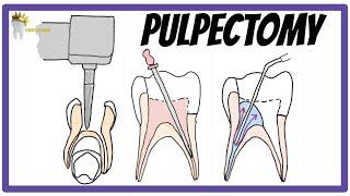 PULPECTOMY | Indications, Contraindications, Rationale, obturation materials