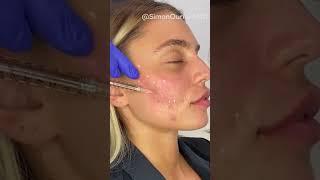 Non-surgical acne scar treatment