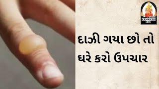 દાઝી ગયા છો તો દવાખાને જવાની જરૂર નથી, ઘરે કરો ઉપચાર | Dharti Goswami