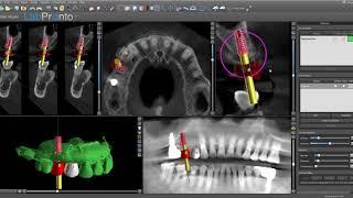 Routine Implant Planning in Blue Sky Plan v 4.5.9