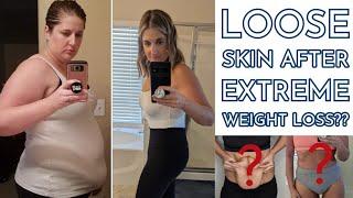 Loose Skin after Losing 100+ Pounds: The Myths and Reality