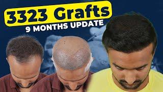 Best Hair Transplant Surat || Implanter FUE Grade-3| 3323 Grafts | Cost of Hair Transplant in Surat
