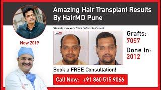 Amazing Hair Transplant Results By HairMD Pune | HairMD, Pune