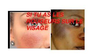 COMMENT FAIRE DISPARAÎTRE LES ROUGEURS SUR LE VISAGE ?