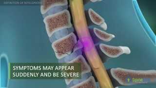 Myelopathy Definition