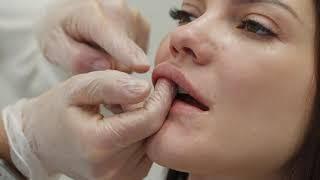 Массаж губ после увеличения гиалуроновой кислотой. Разбираем технику и ошибки  DUZHY