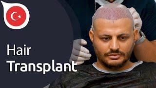 My Experience with Istanbul Vita from Germany | Hair Transplant in Istanbul / Turkey