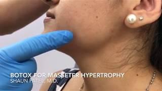 Botox treatment of the masseter muscle by Dr Shaun Patel in Miami, Florida