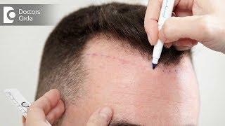 Is a Hair Transplant Painful? - Dr. Srikanth V