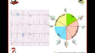 Ecg Podcast 22 of 59. Hemibloky.