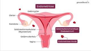 Was ist Endometriose und wie entsteht sie?