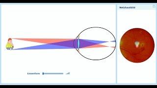 Wie es zu Kurzsichtigkeit kommt: Physik - richtig gut erklärt.