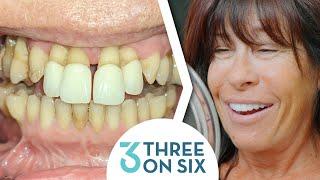 Affordable Dental Implants and Bridges with 3 on 6