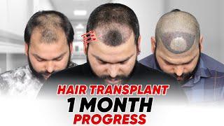 Hair Transplant in Rourkela | Best Results & Cost of Hair Transplant in Rourkela