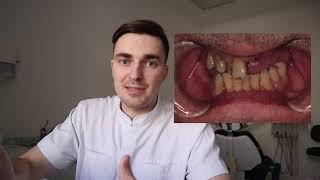 НЕТ ЗУБОВ! Что делать? #зубныепротезы #стоматология