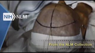 Prefrontal Lobotomy in the Treatment of Mental Disorders (GWU, 1942)