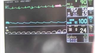 Why a Sodium Bicarbonate Bolus is a Really Bad Idea