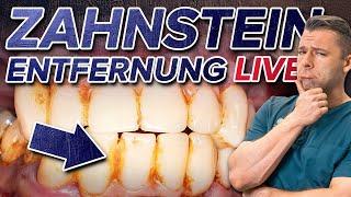 Zahnsteinentfernung LIVE  - So läuft es ab! Trotz Angst Zahnstein loswerden 