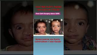 We are doing daily free plastic surgery for cleft lip & palate children since 1999