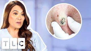 Top 5 Pimple Popping Moments: From A 55-Year-Old Blackhead To Oozing Fistulas!!