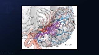 Resection of a Temporal Sylvian Arteriovenous Malformation in a Child