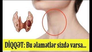 Düyünlü ur (ZOB) xərçəngə səbəb ola bilərmi?— ƏLAMƏTLƏRİ