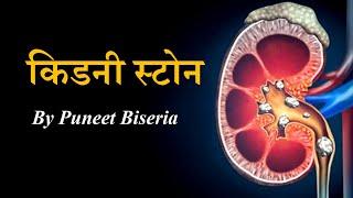 Kidney stones ka BEST Ilaaj by Puneet Biseria | पथरी को जड़ से खत्म करने वाले 9 आहार