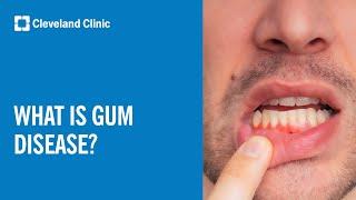 What Is Gum Disease?