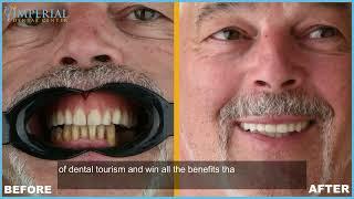 FIXED WORK ON 4 DENTAL IMPLANTS - IMPERIAL DENTAL CENTER - DENTAL TOURISM ALBANIA