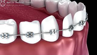 Animated Traditional Braces | Apollo Medical Travel