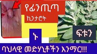 #101 የፊንጢጣ ኪንታሮት ፍቱን መድሃኒት!!  በቤት ውስጥ(@EthiovisionEntertain