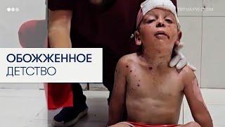 Дети получили серьезные ожоги в результате израильского удара по Газе