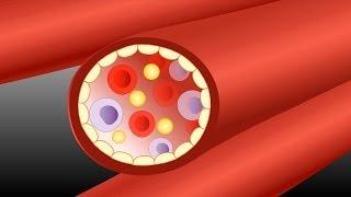 Atheroma in the artery