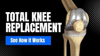 See how a Total Knee Replacement works in 3D animation