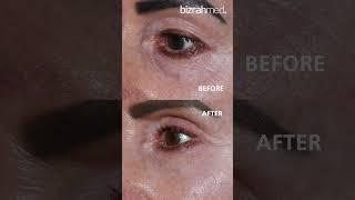 Blepharoplasty (Eyebags Removal): Before and After Results  | Bizrahmed Center 