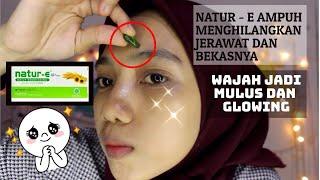 NATUR - E AMPUH MENGHILANGKAN JERAWAT DAN BEKASNYA  || WAJAH JADI MULUS DAN GLOWING