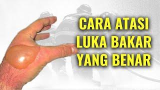 CARA MENGATASI LUKA BAKAR yang BENAR, Luka Ringan, Sedang, dan Berat |Mastha Bahas Kesehatan #02