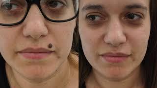 Facial mole removal demo - large mole removed from upper lip - fast and pain free.