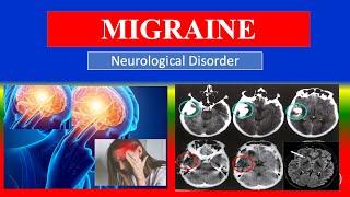 MIGRAINE - Definition, types, causes, pathophysiology, symptoms , treatment , medicine