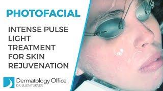 Photofacial