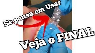 INVISALIGN FUNCIONA ?! DISSE TUDO