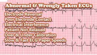 Abnormal & Wrongly Recorded ECGs | Electrode Reversal | Poor Contact | Over & Under Calibration