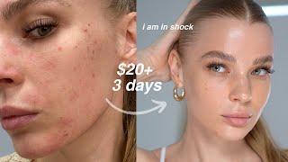 how i accidentally healed my skin barrier in 3 days