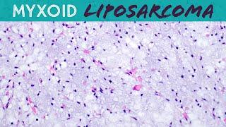 Myxoid Liposarcoma (explained in 5 minutes) basic soft tissue pathology sarcoma pathologists