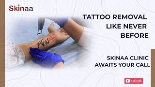 Experience Tattoo Removal Like Never Before: Skinaa Clinic Awaits Your Call