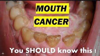 MOUTH CANCER - Symptoms , risk factors , prevention !