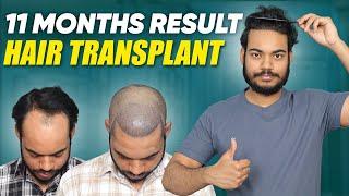 Hair Transplant in Dhaka | Best Results & Cost of Hair Transplant in Dhaka