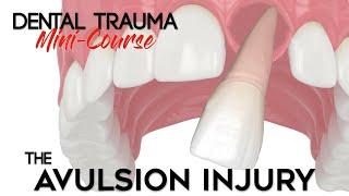 Dental Trauma Mini-Course - Part 12 - Dental Trauma Guide - The Avulsion Dental Injury